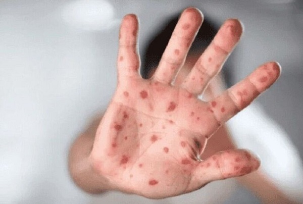 امکان نابودی بیماری آبله میمونی در اروپا امکان نابودی بیماری آبله میمونی در اروپا